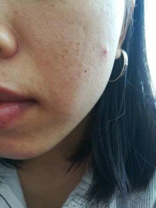 痘痘如何去除效果好（痘痘咋去除）