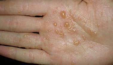 脚痒脱皮起水泡烂脚丫用什么药最好（脚脱皮起泡痒用什么药）