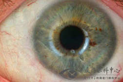 胬肉（胬肉最怕三个眼药水）